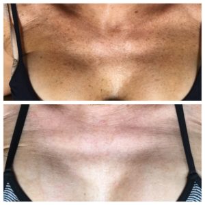 IPL Before and After Chest