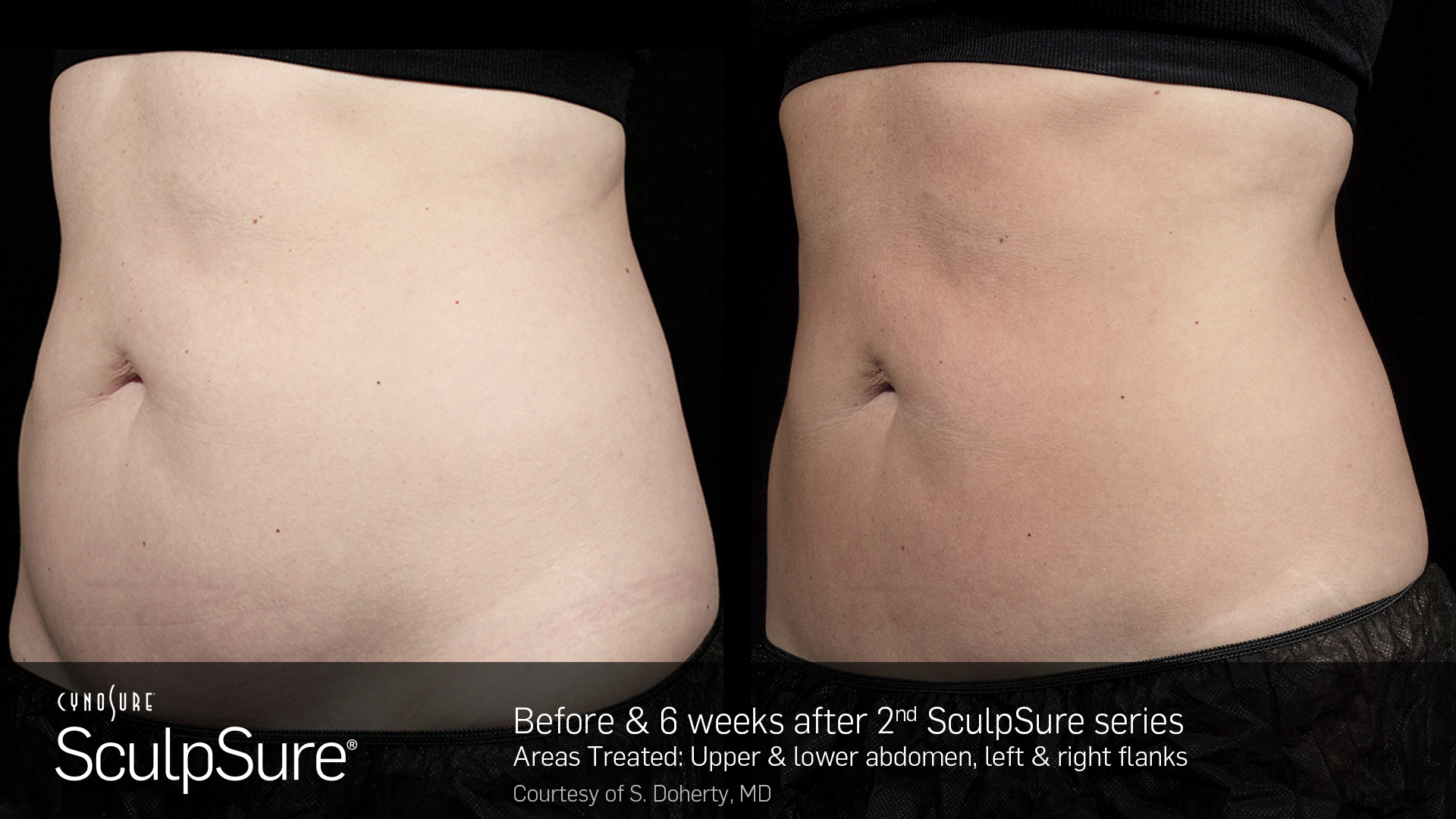 SculpSure Body Contouring abdomen before and after