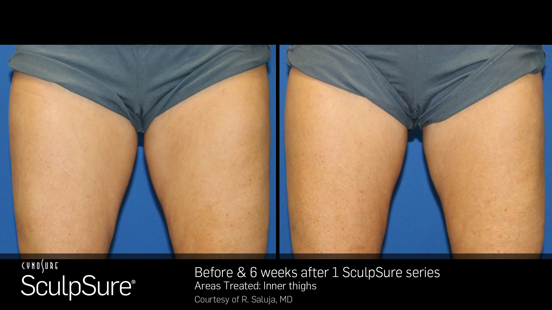 SculpSure Body Contouring Inner Thigh Before and After