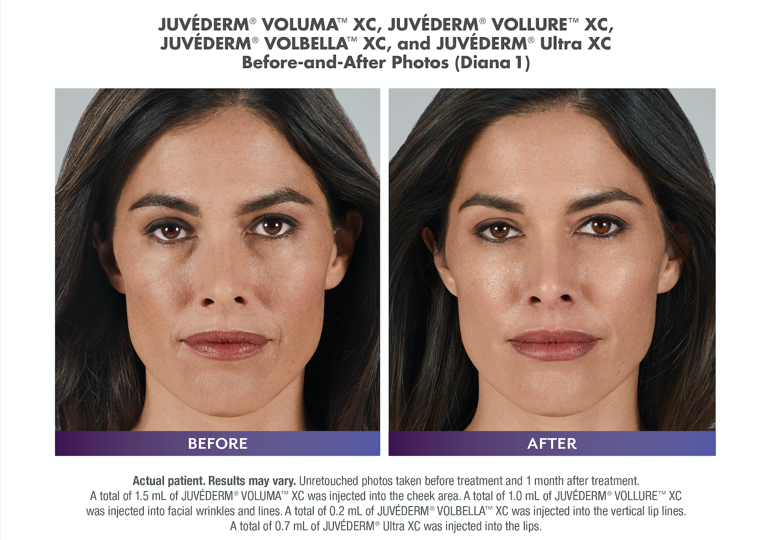 juvederm filler before and after