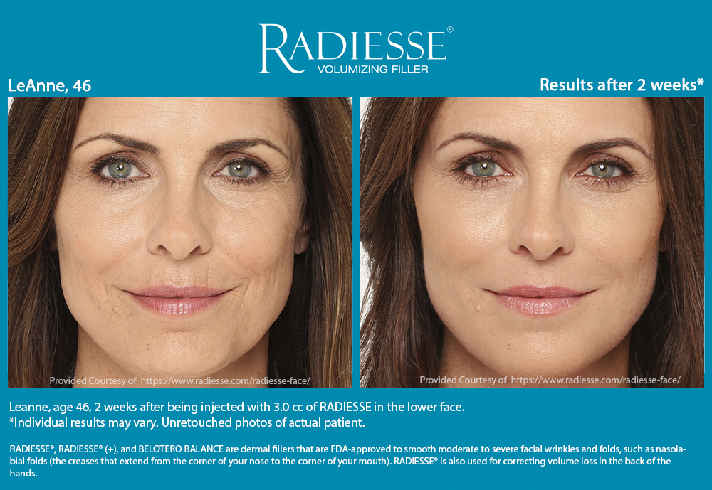 radiesse filler before and after